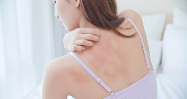 Eczema treatment